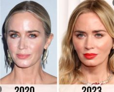 Emily Blunt Botox and Nose Surgery