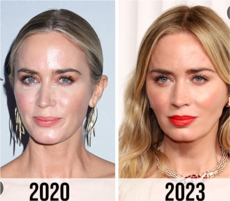 Emily Blunt Botox and Nose Surgery
